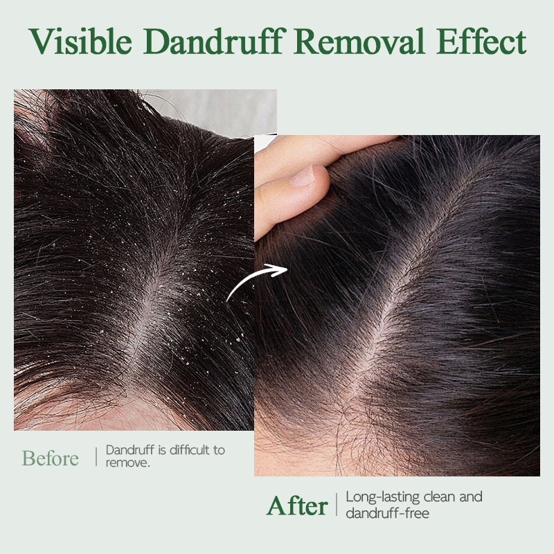 Ropink Mugwort Scalp Detox