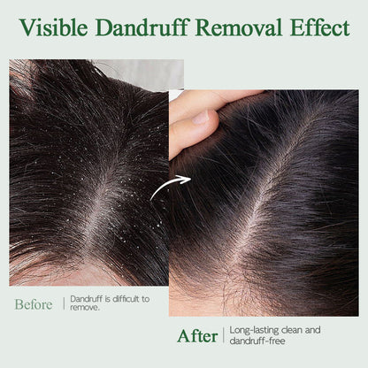 Ropink Mugwort Scalp Detox